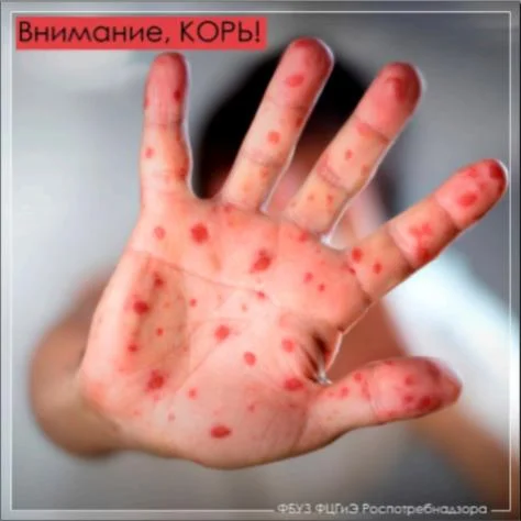 ВНИМАНИЕ КОРЬ